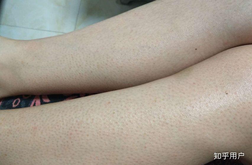 鸡皮肤deren(鸡皮肤的人能不能做冰点脱毛) 鸡皮肤deren(鸡皮肤的人能不能做冰点脱毛)