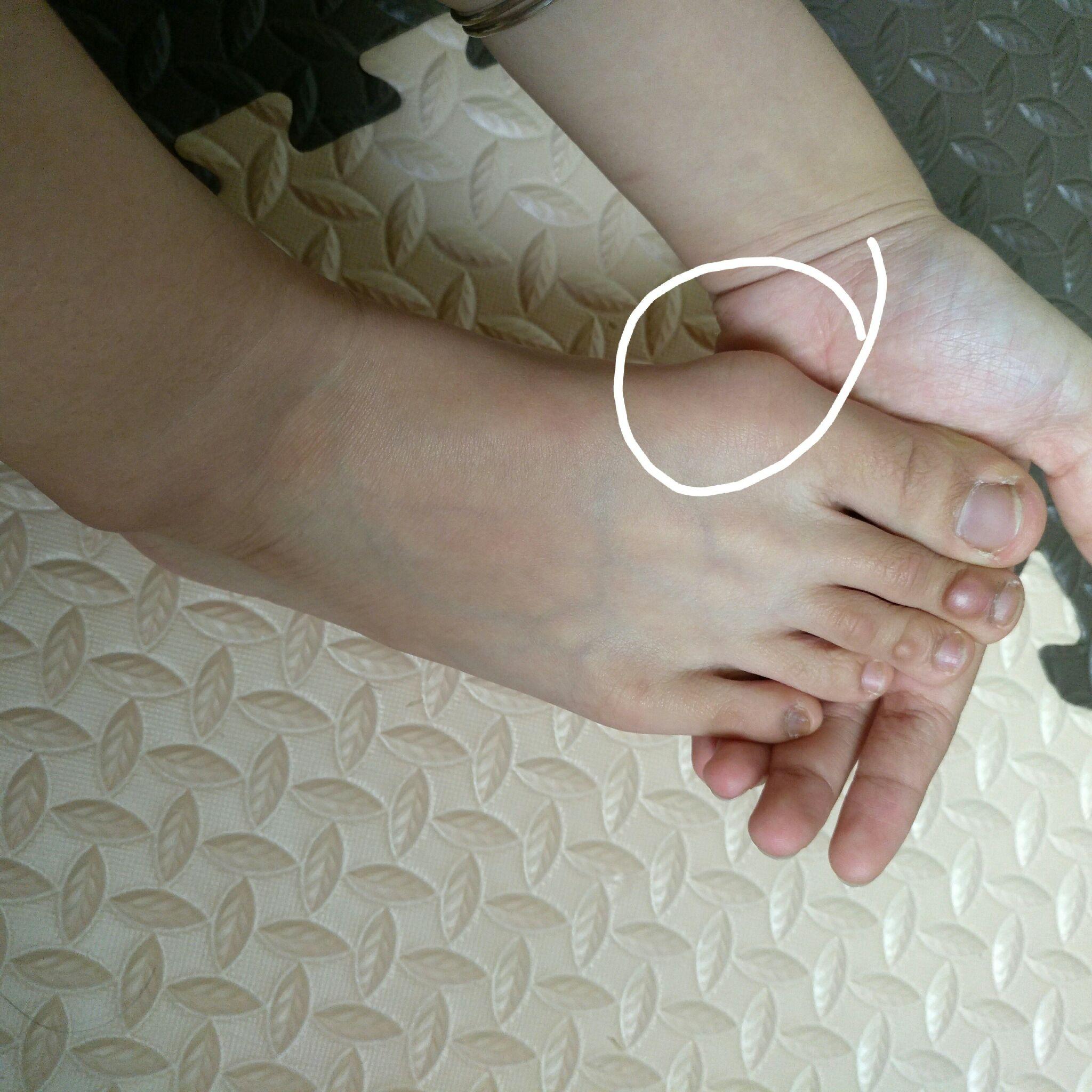 作为一个女生,脚拇指外翻是一种怎样的体验? - 知乎