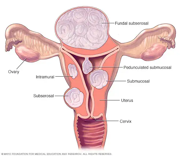 4109 2000 fibroids-anthony-siow