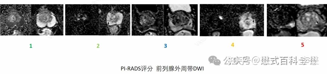 前列腺磁共振中mp-MRI、bp-MRI和abp-MRI - 知乎