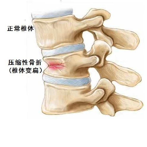 得了骨质疏松是一种怎样的体验