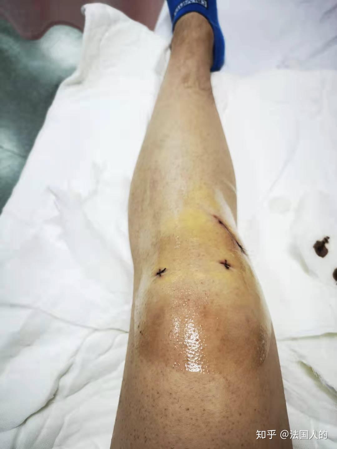 膝盖前交叉韧带断裂是一种什么样的体验