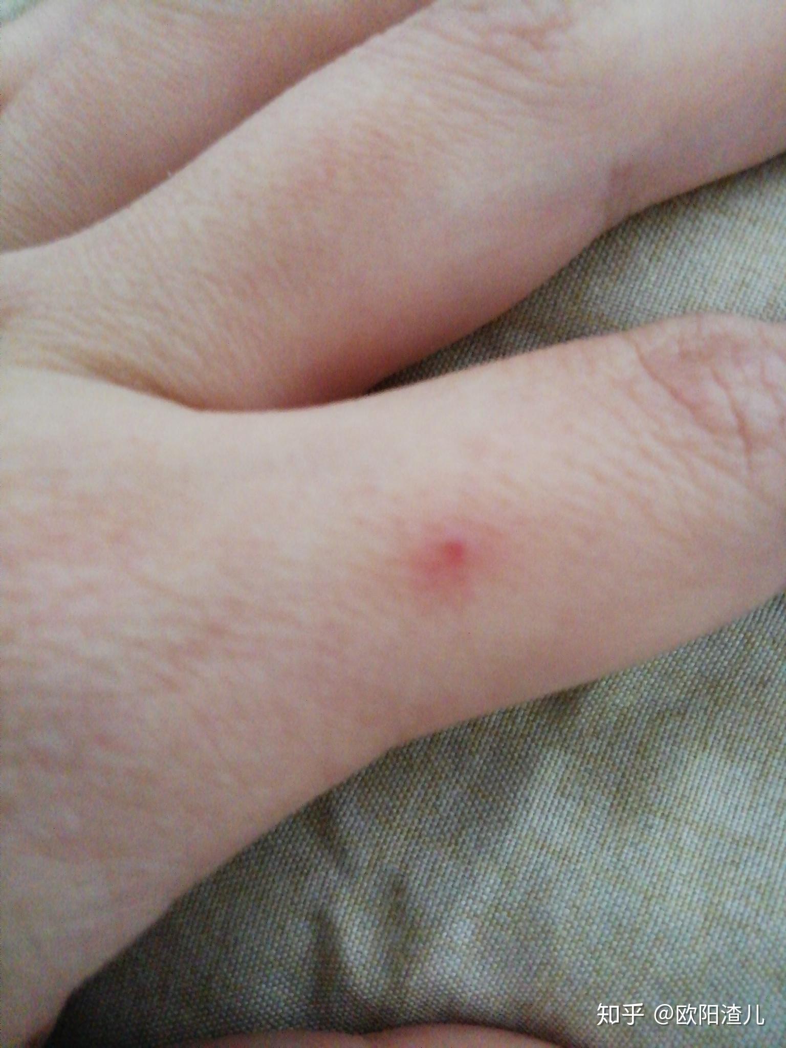 这是血管痣吗? - 知乎