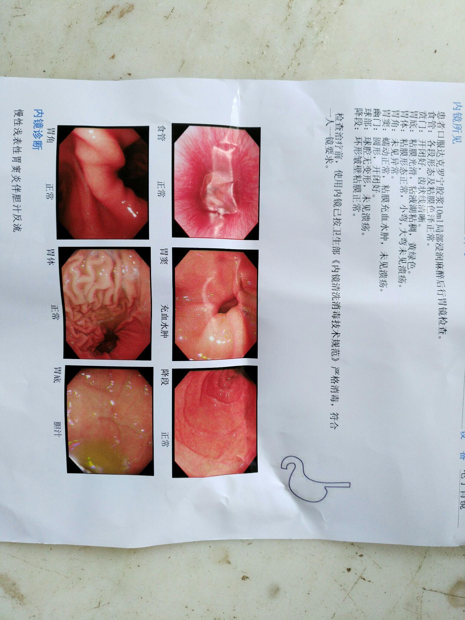 做胃镜是种怎样的体验