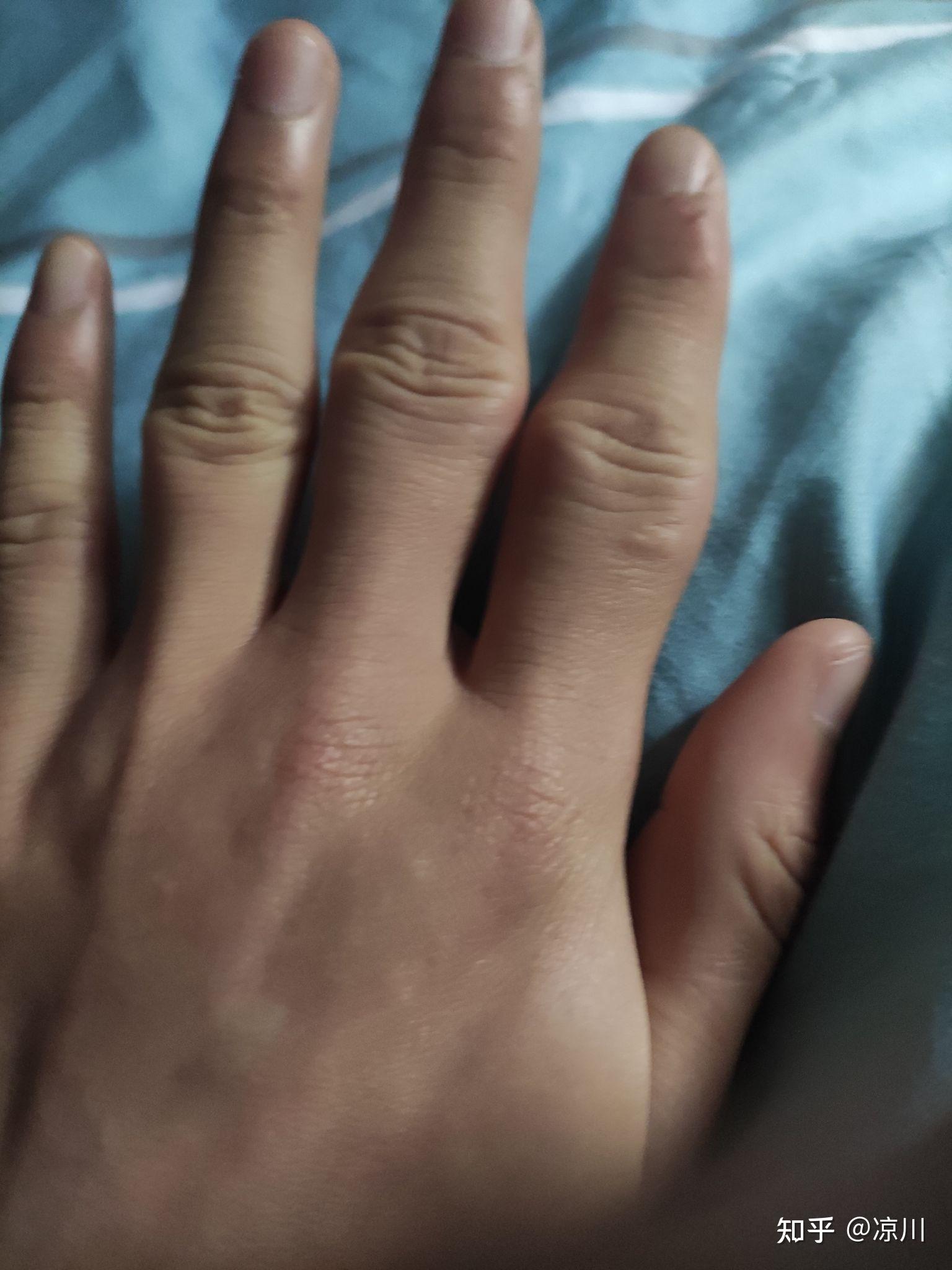 手指关节粗大,褶皱多怎么改善? 