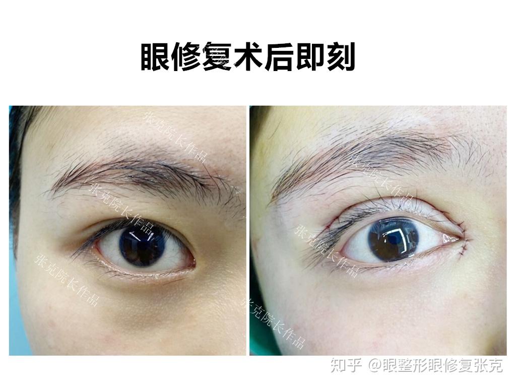 可以发一下你们开眼角的前后对比图吗?