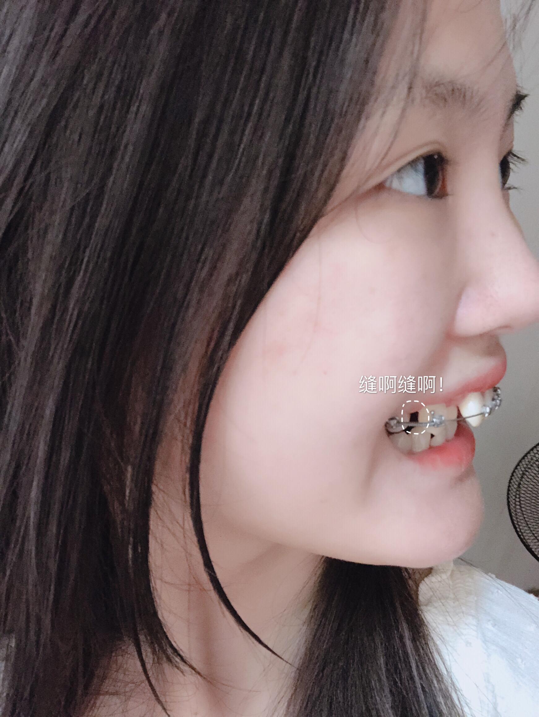 戴过牙套(矫正牙齿)的人脸型变了吗? - 知乎