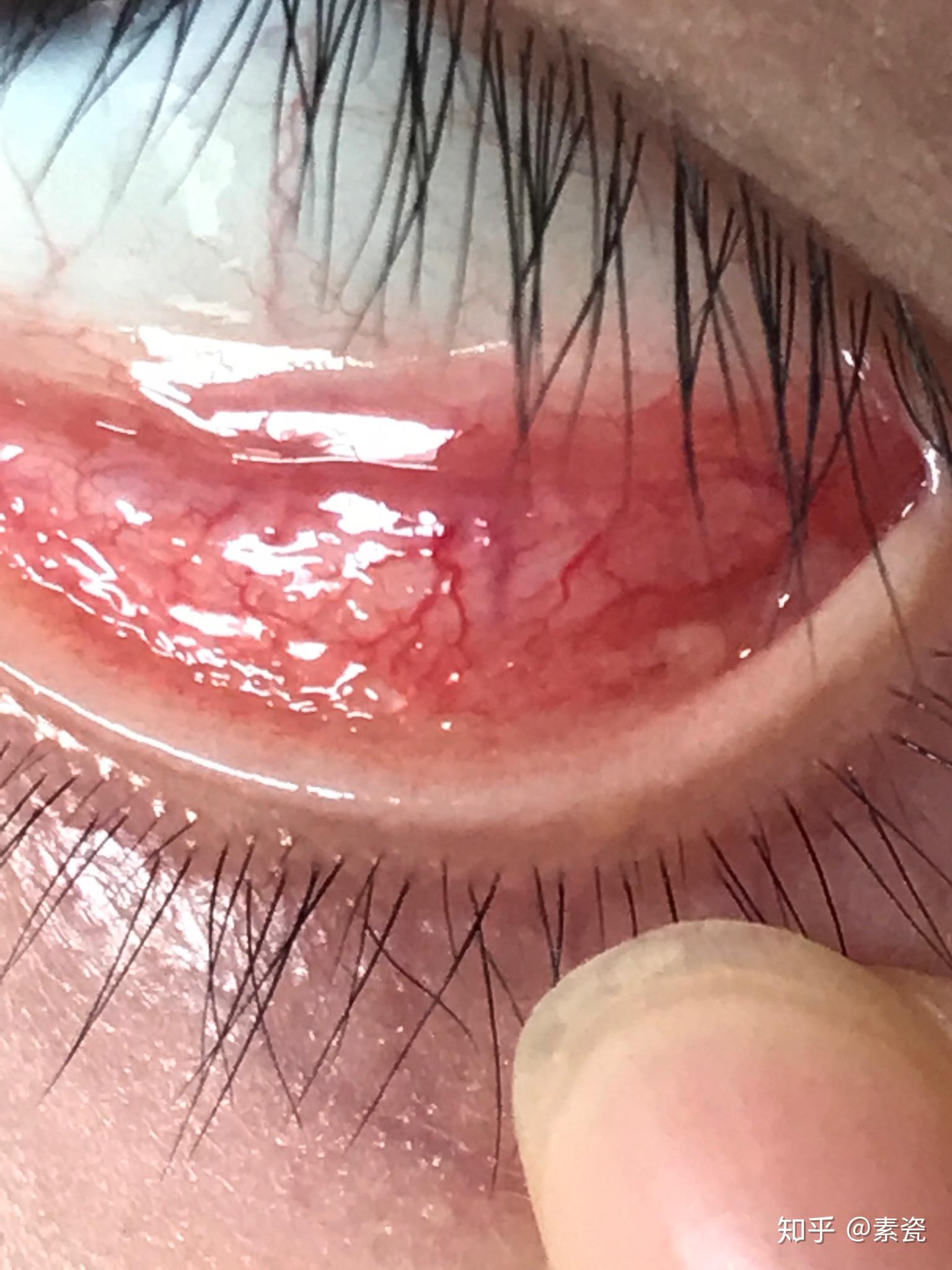 滤泡性结膜炎如何能有效治疗之前会怕光流眼泪眼干涩疼痛现在这些症状