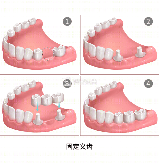 假牙是如何固定在嘴里的？ - 知乎