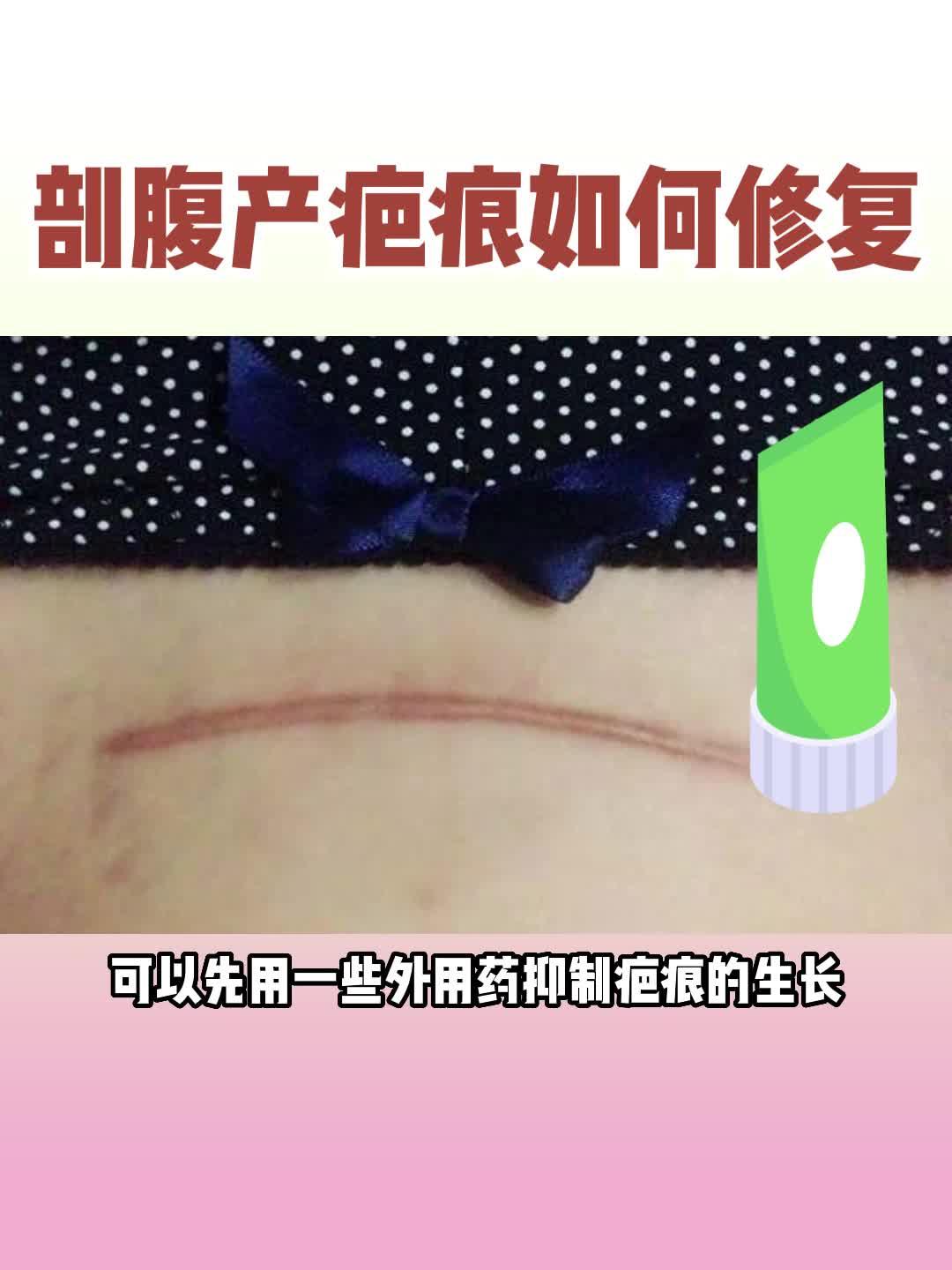 剖腹产后的疤痕如何祛除? - 知乎