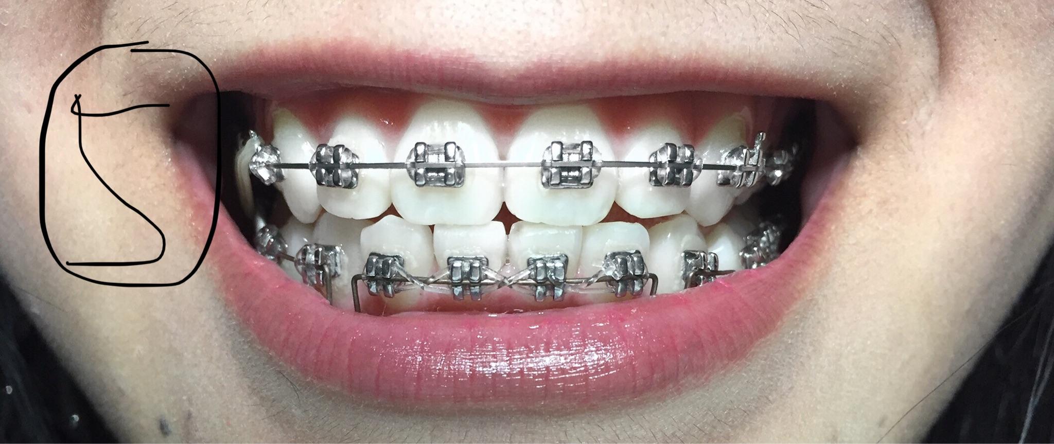 请问可不可以只矫正上牙