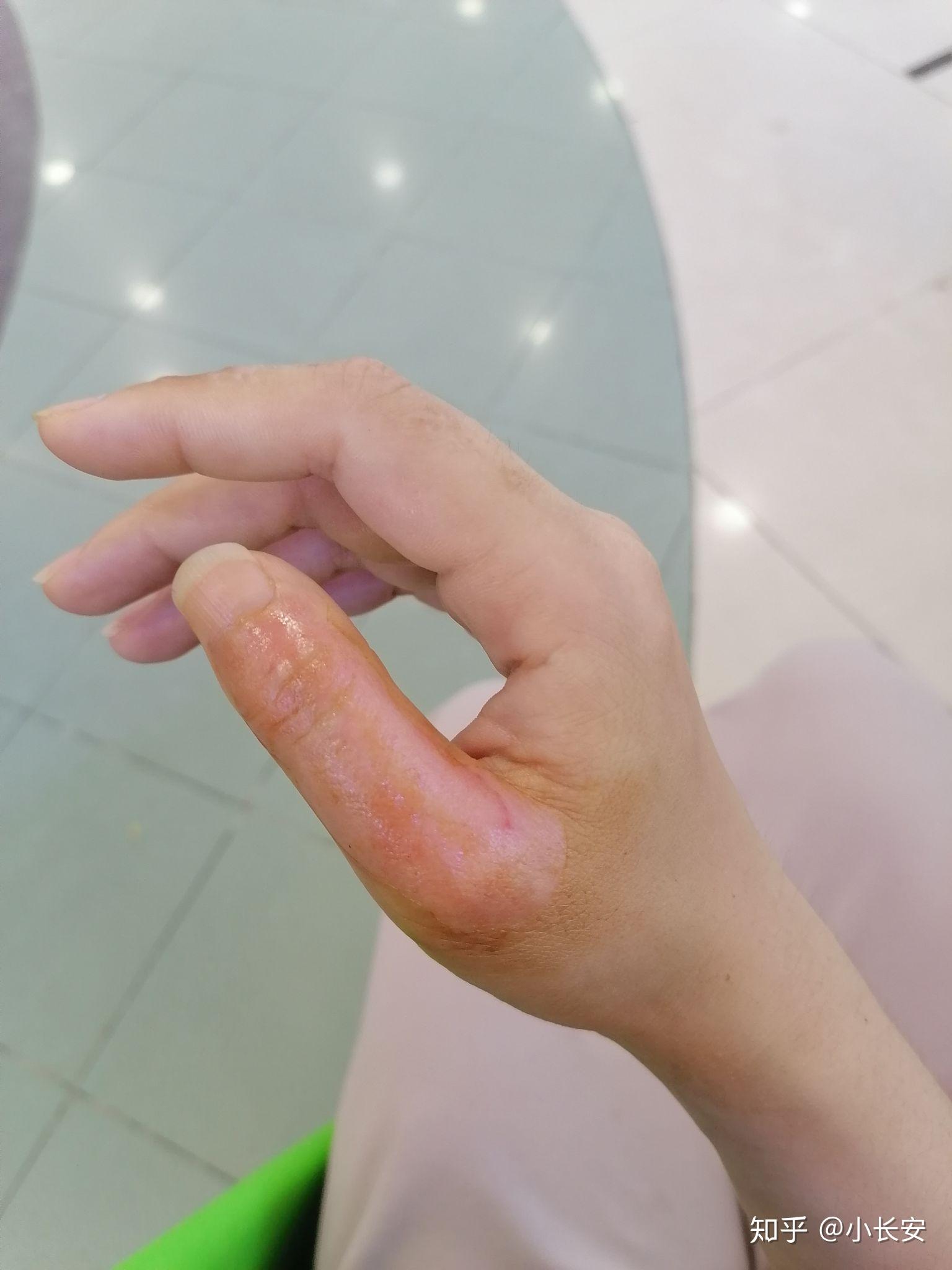 手背开水烫伤怎么恢复