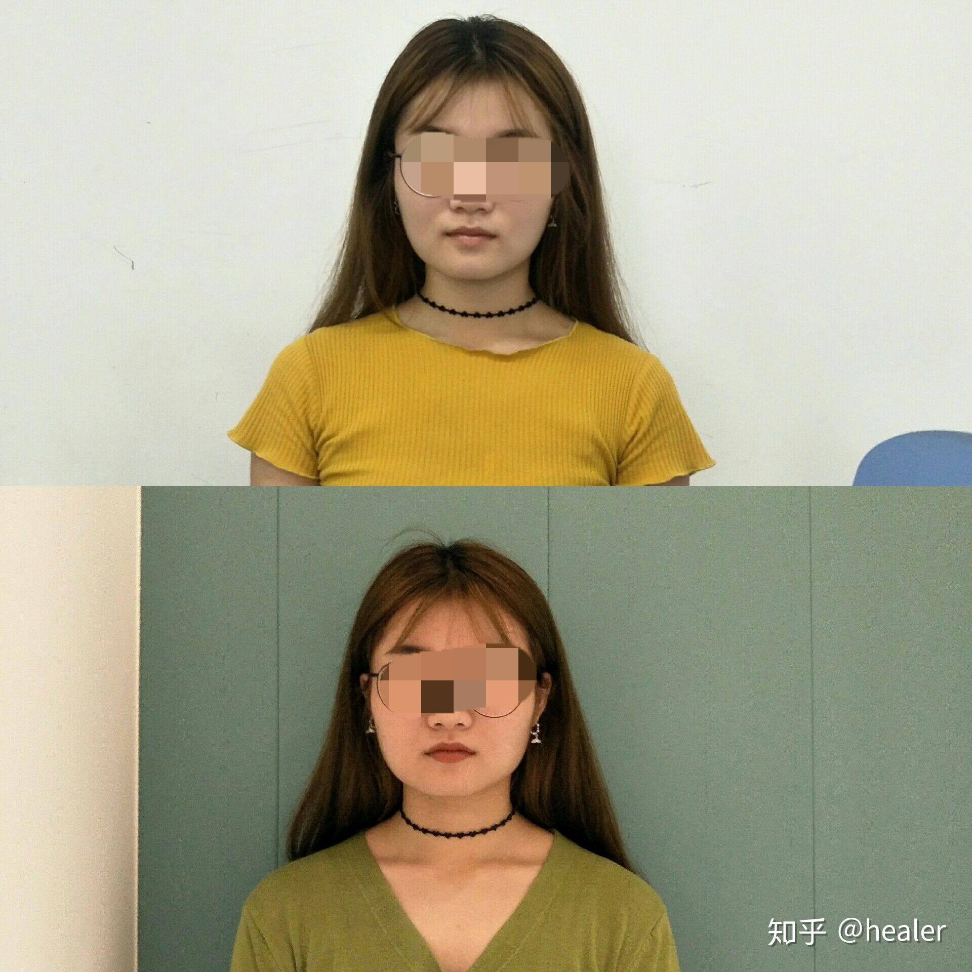 瘦脸针持续时间_瘦脸针效果持续多久_瘦脸针一般持续多久