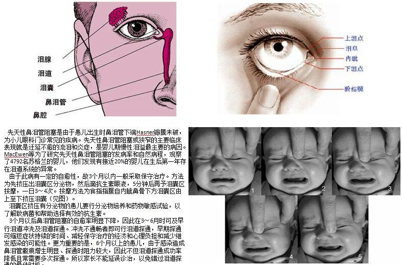 嬰兒鼻淚管堵塞會自愈嗎是不是一定要衝洗或者通淚管呢