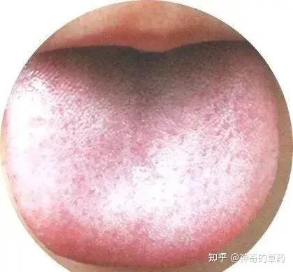 舌诊图谱130种(建议收藏) - 知乎