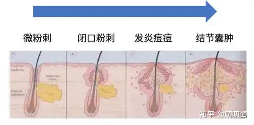 如何一周告别黑头与粉刺,轻松拥有蛋壳肌肤?快来听皮肤科医生怎么说! - 知乎