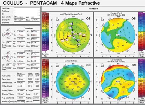 角膜地形图高度图分析图片