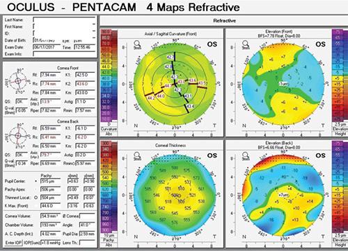 pentacam 提供有关前段参数的详细信息,包括前部和后部角膜轮廓和高度