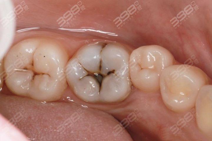 了解完补牙的全过程,其实补牙没那么可怕 - 知乎