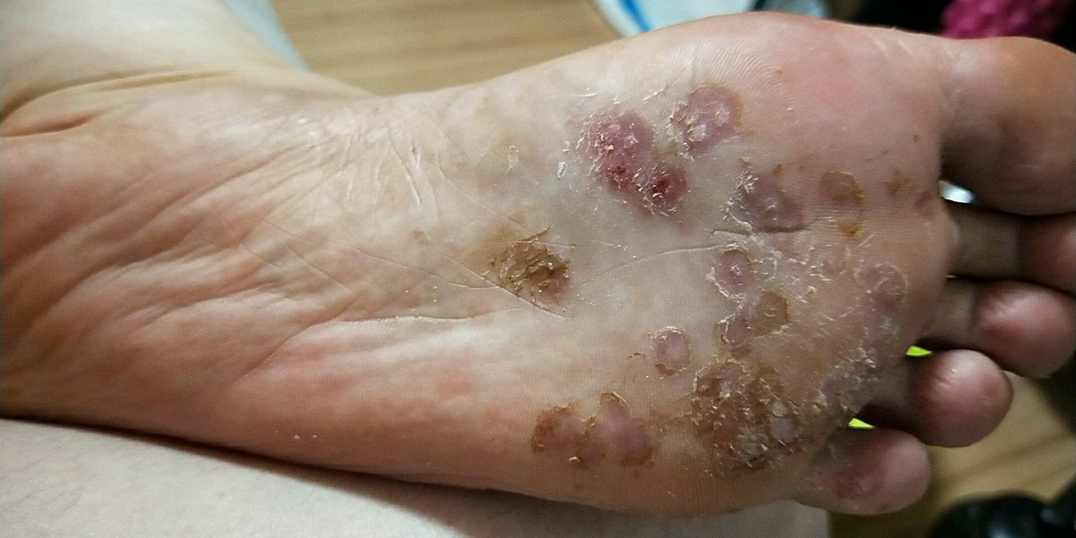 跖疣的透明角质怎么一直除不掉? - 知乎