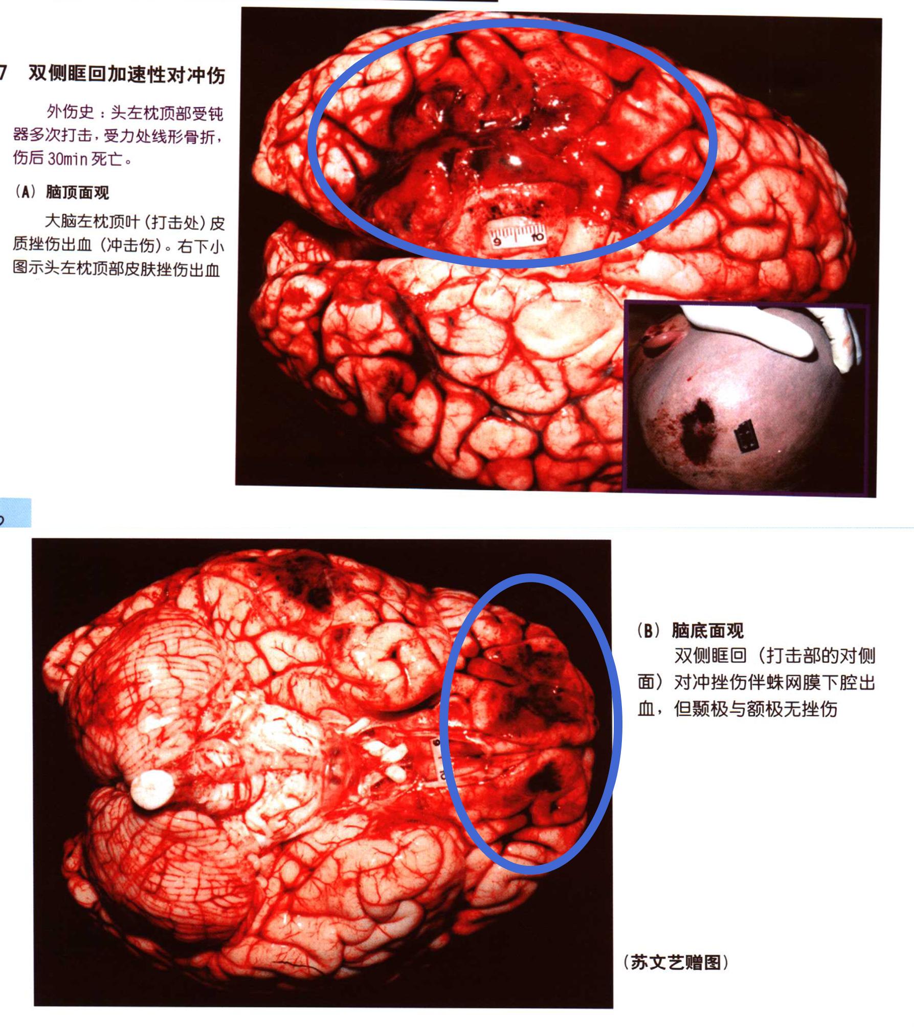 人脑脑浆图片图片