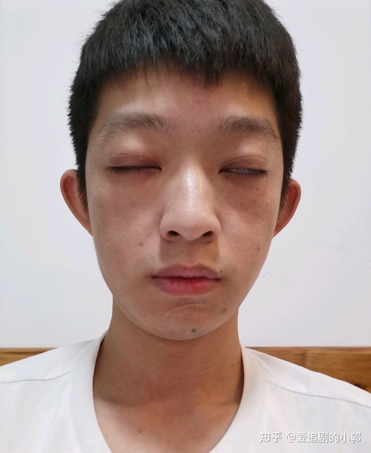 给甲亢凸眼的病友们提供一个我的案例参考