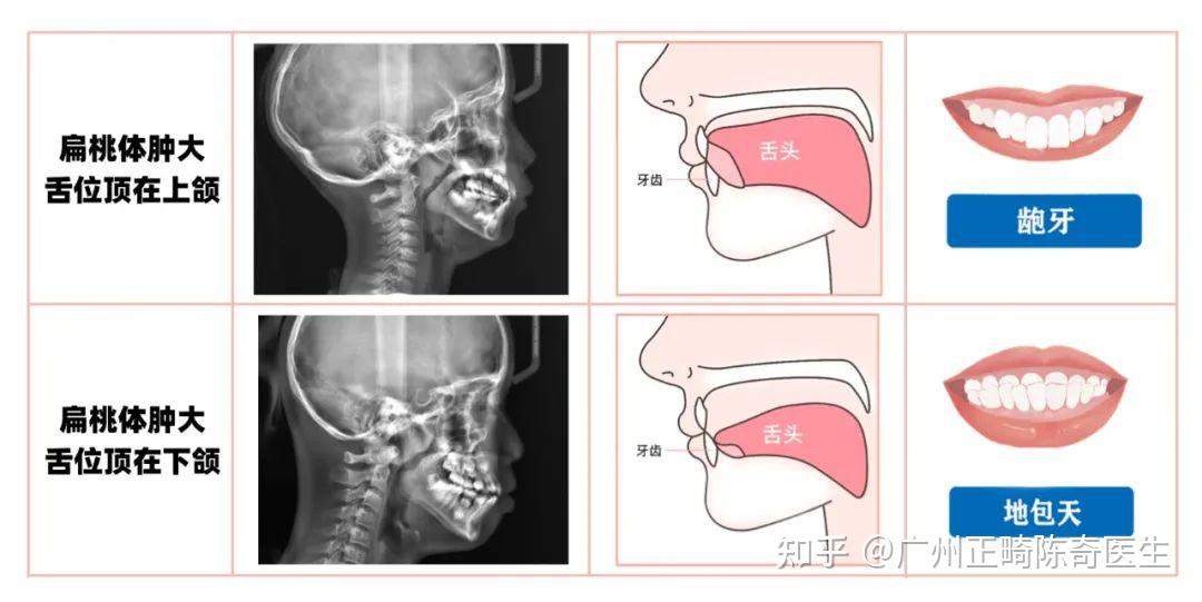 舌头的正确安放位置? - 知乎
