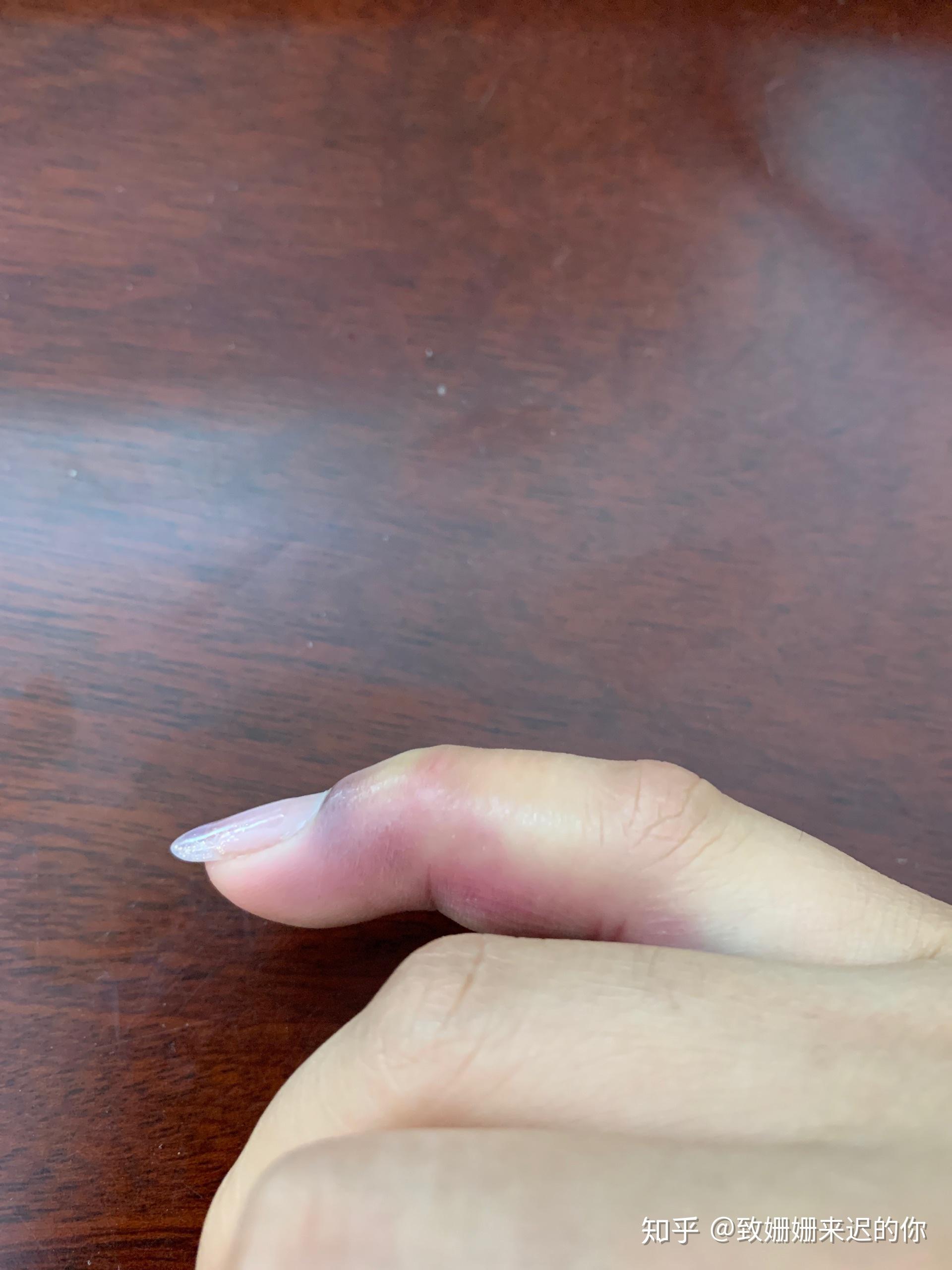 手指肌腱断裂最后一节无法伸直医生教我不要治疗了请问我该怎么做不