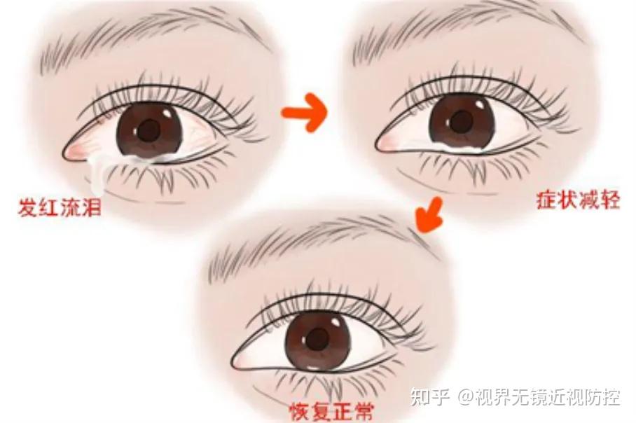 知识科普丨眼泪的三种模样 - 知乎