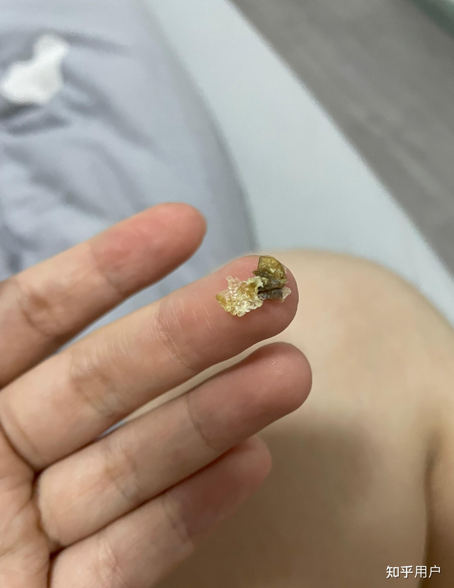 耳屎能大到什么程度? - 知乎