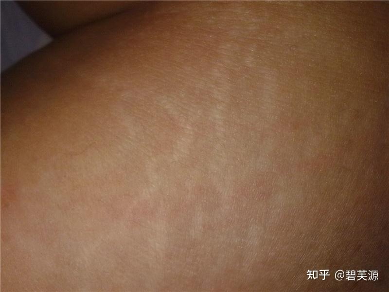 什么是橘皮纹以及有了橘皮纹怎么办 - 知乎