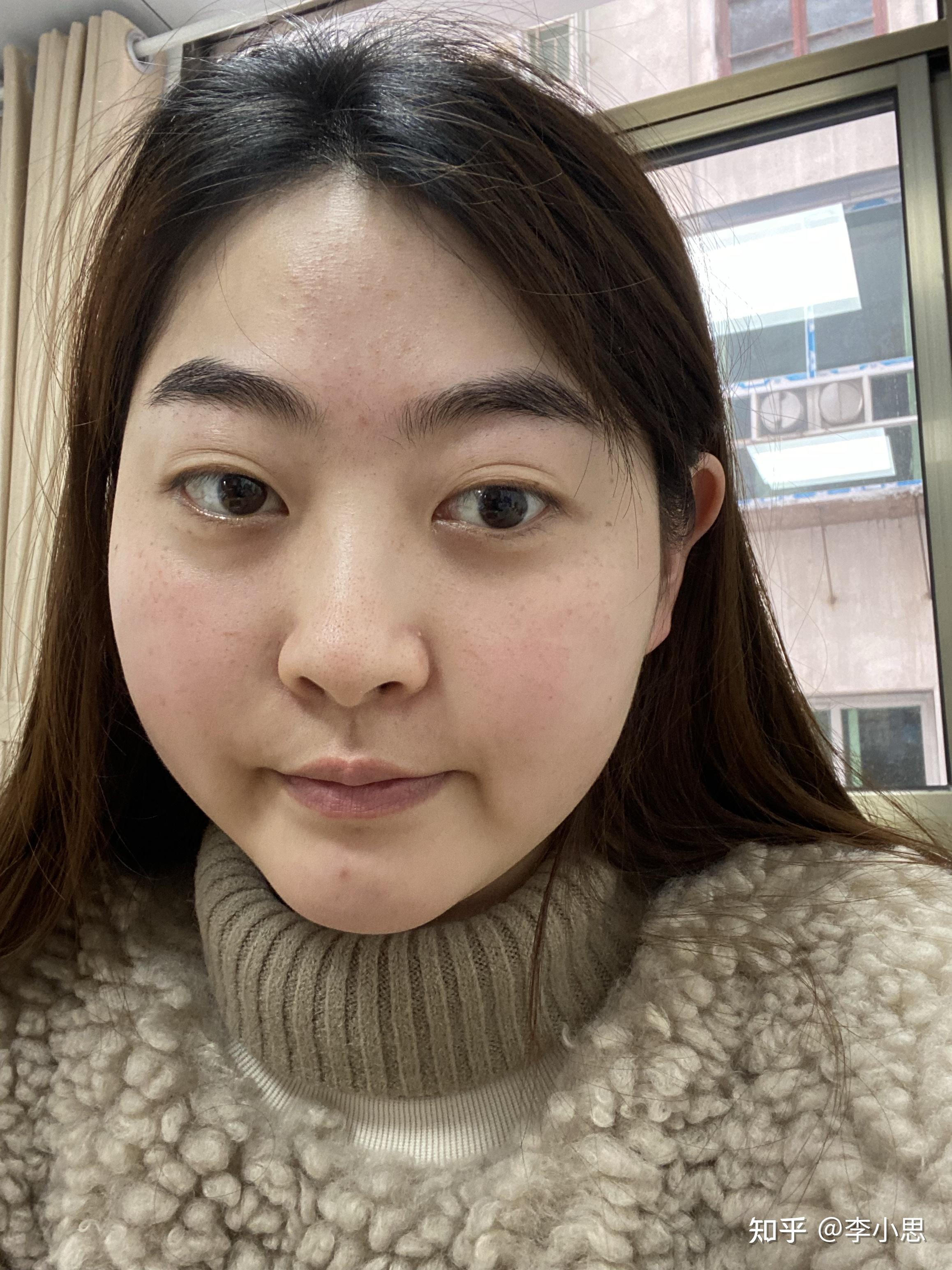 吃糖皮质激素引起的满月脸可以完全恢复吗? - 知乎