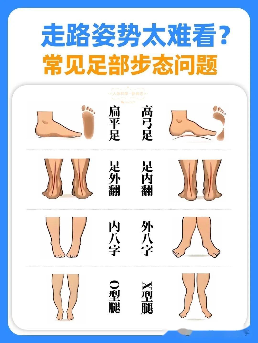 【步态评估】走路姿势太难看，一图看懂常见足部步态问题 - 知乎