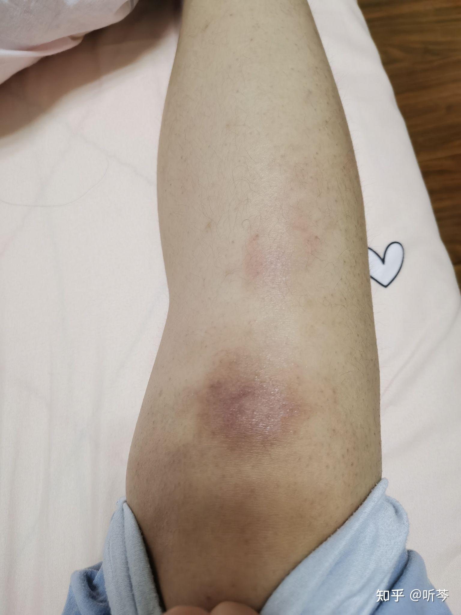 擦伤后疤痕怎么去除 - 知乎