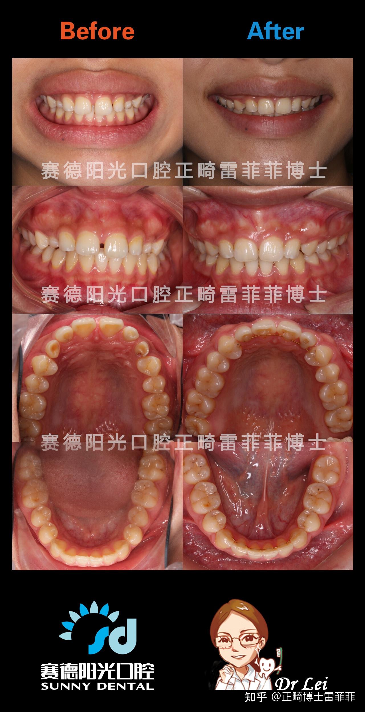牙骨混合凸嘴矫正，重塑立体五官|济南牙齿矫正 - 知乎