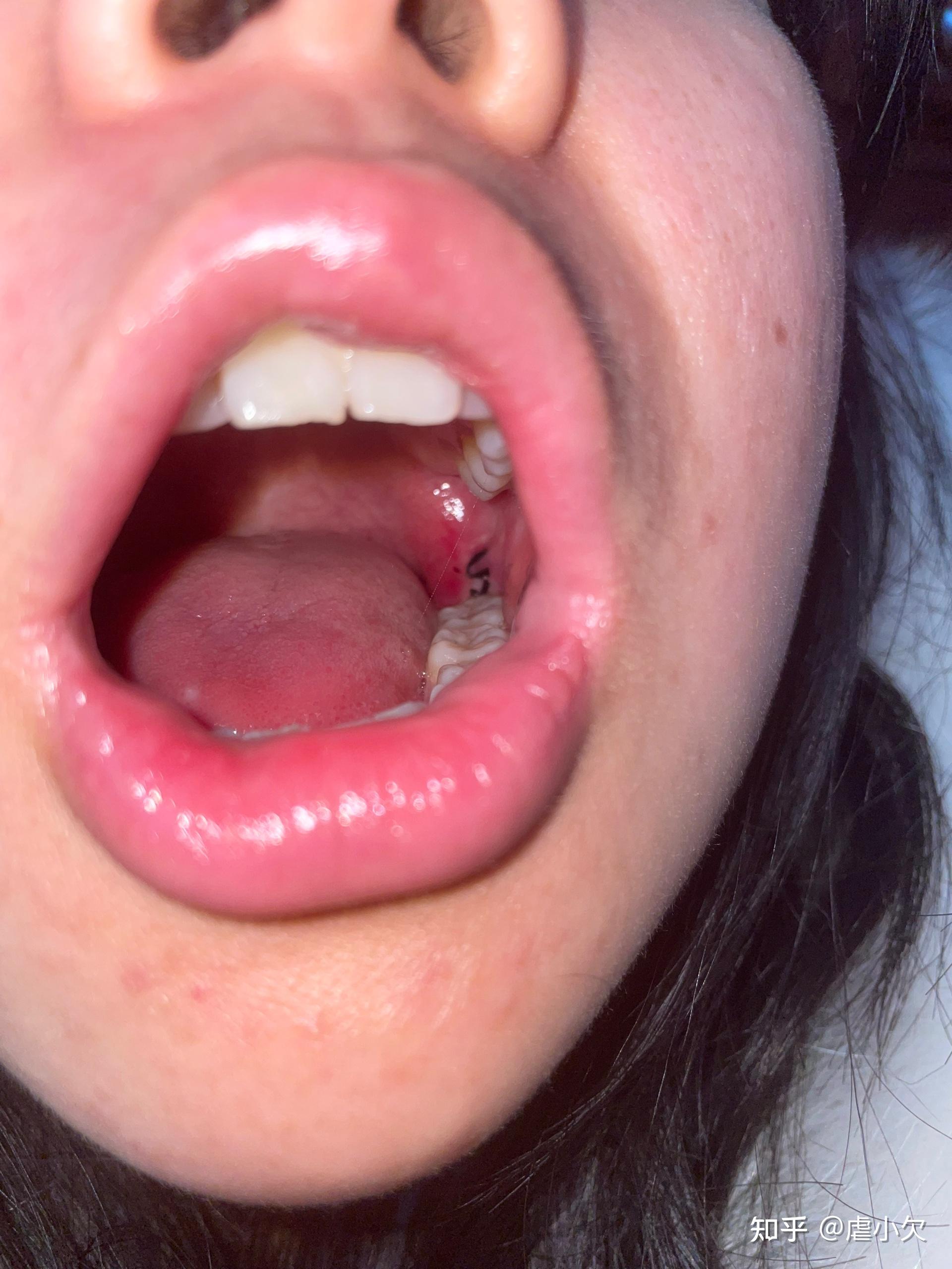 拔阻生智齿有多难受