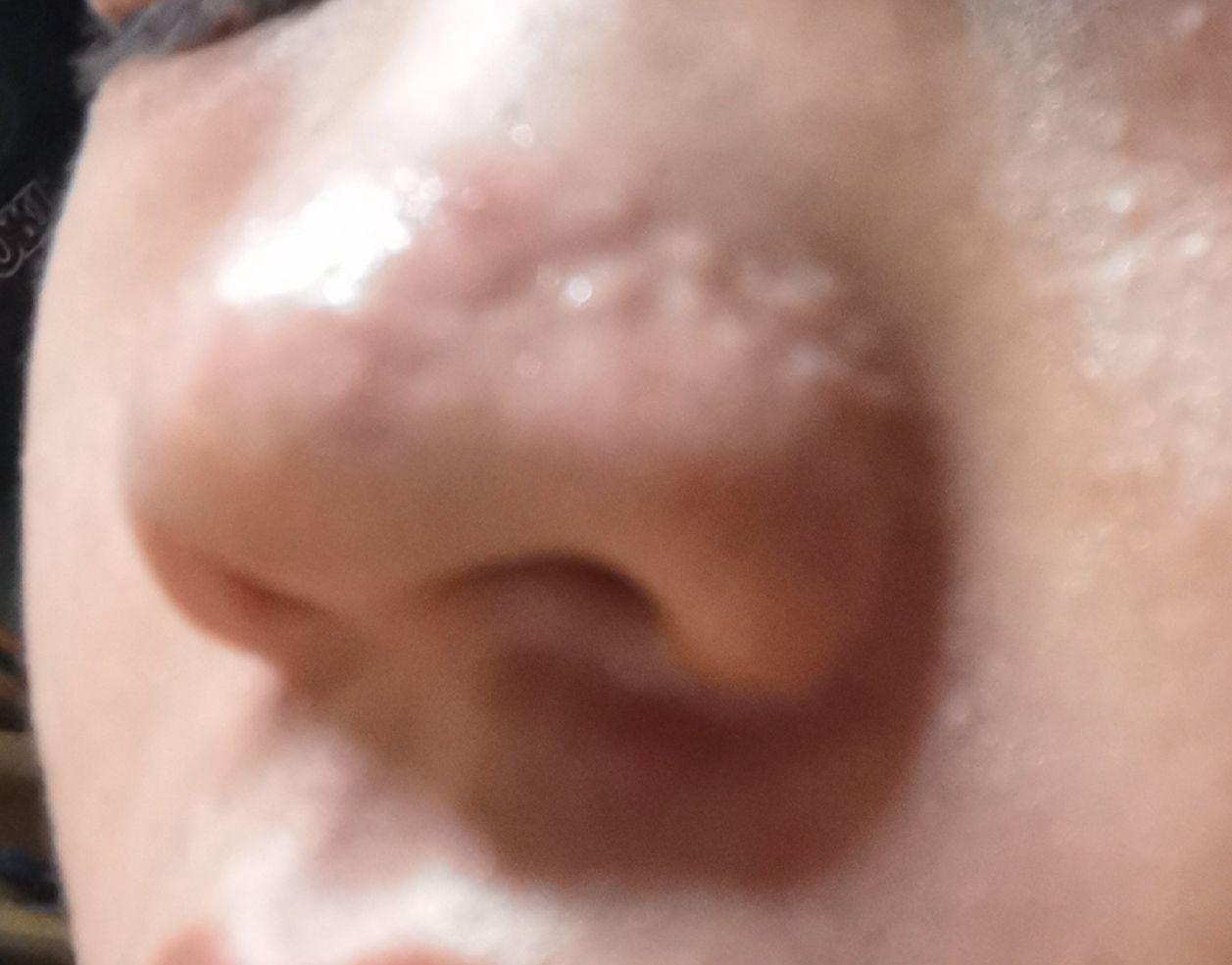 鼻子上增生和凹凸不平能用点阵激光治疗吗