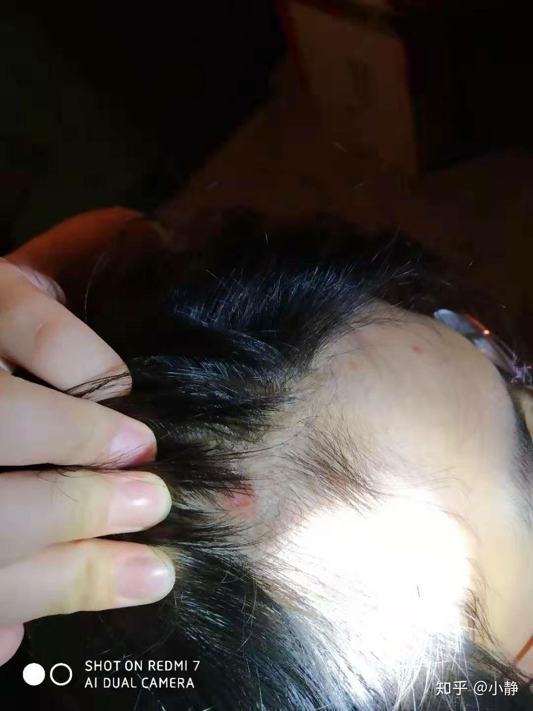 头上长了很多红红的疙瘩靠近额头的那几个我看起来像痘痘一样请问是