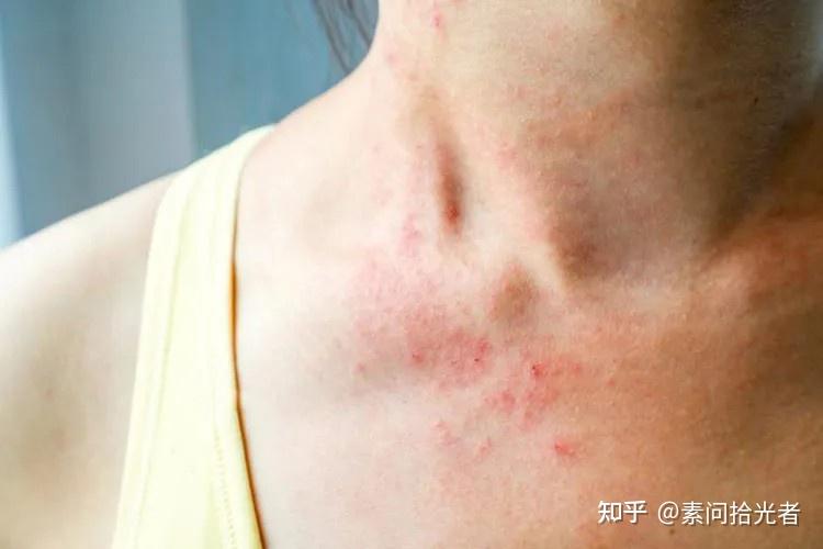 皮肤痒起疹子怎么办? - 知乎