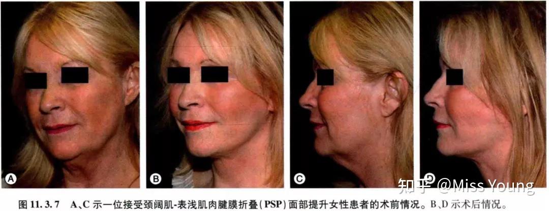 面部皱纹都有哪些种类?形成原因?如何除皱? - 知乎