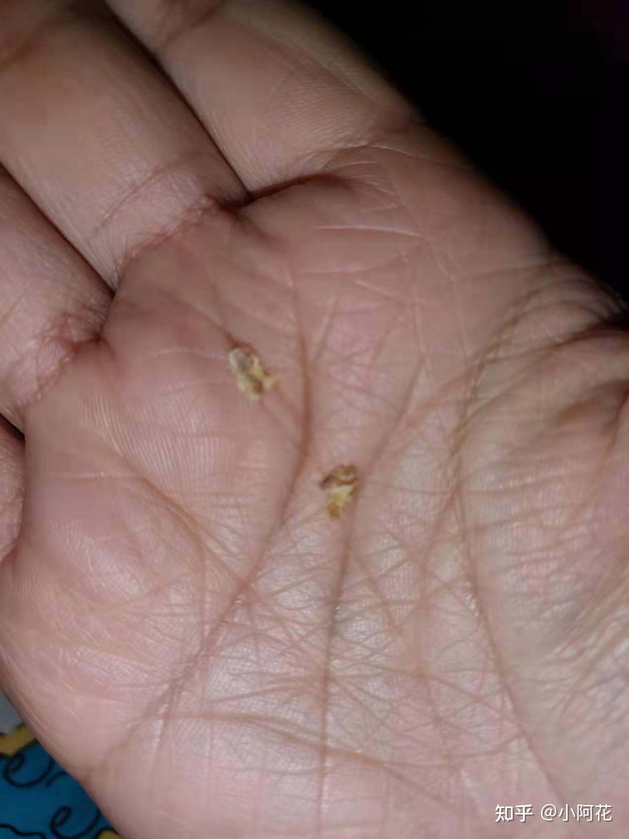 3岁女宝耳朵的耳屎堵住怎样清理? - 知乎