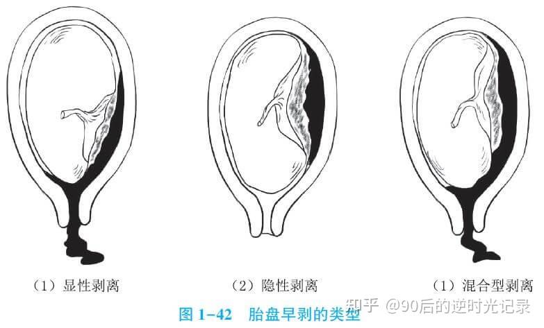 胎盘前壁图片图片