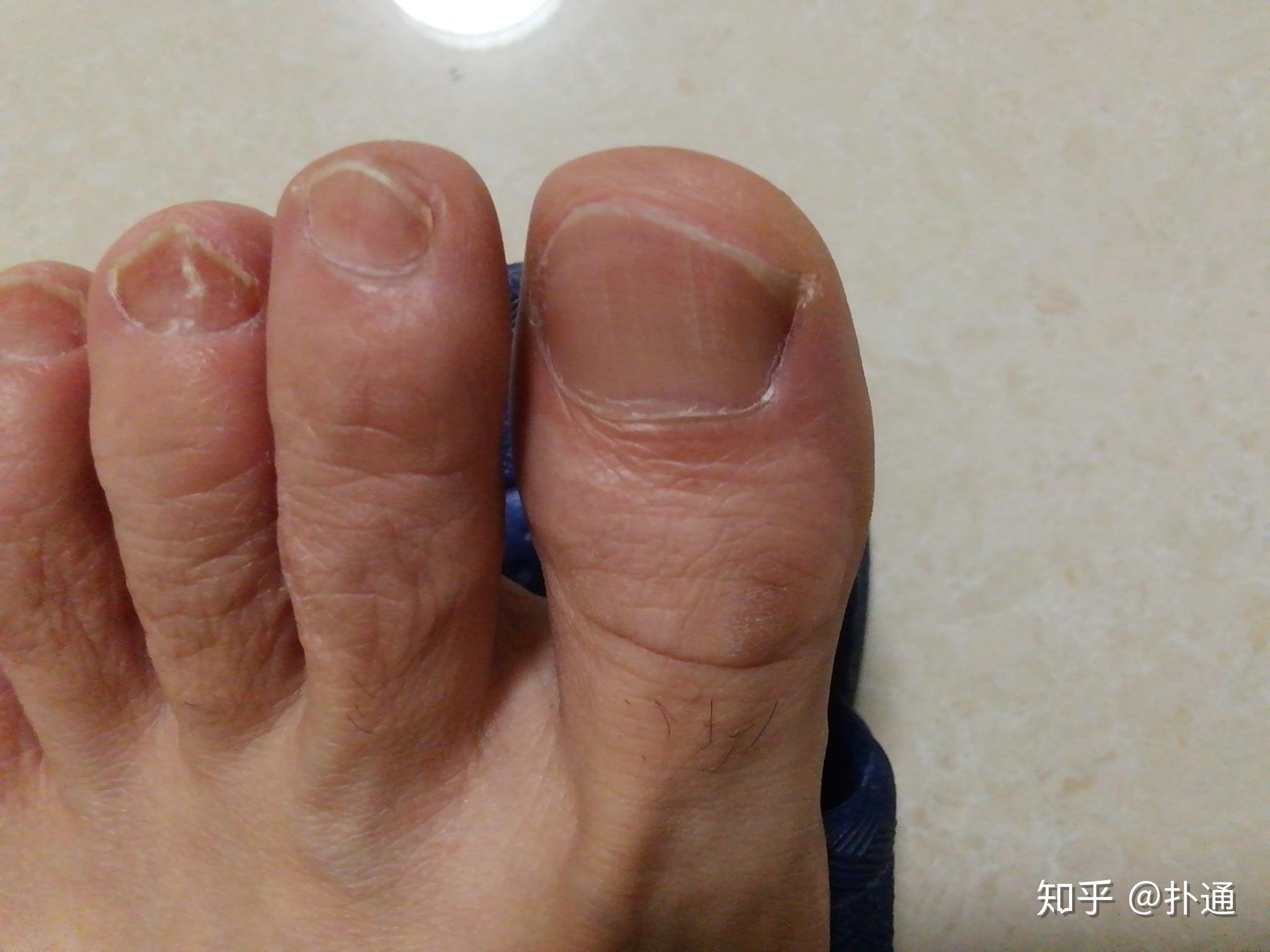 脚指甲中间凹进去了有一条像沟痕迹是为什么