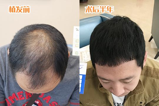 防止植发失败，判断是否适合植发更重要？ - 知乎