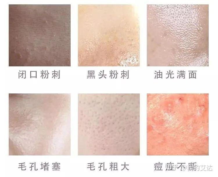 粉刺、闭口、黑头、痘痘,一网打尽! - 知乎
