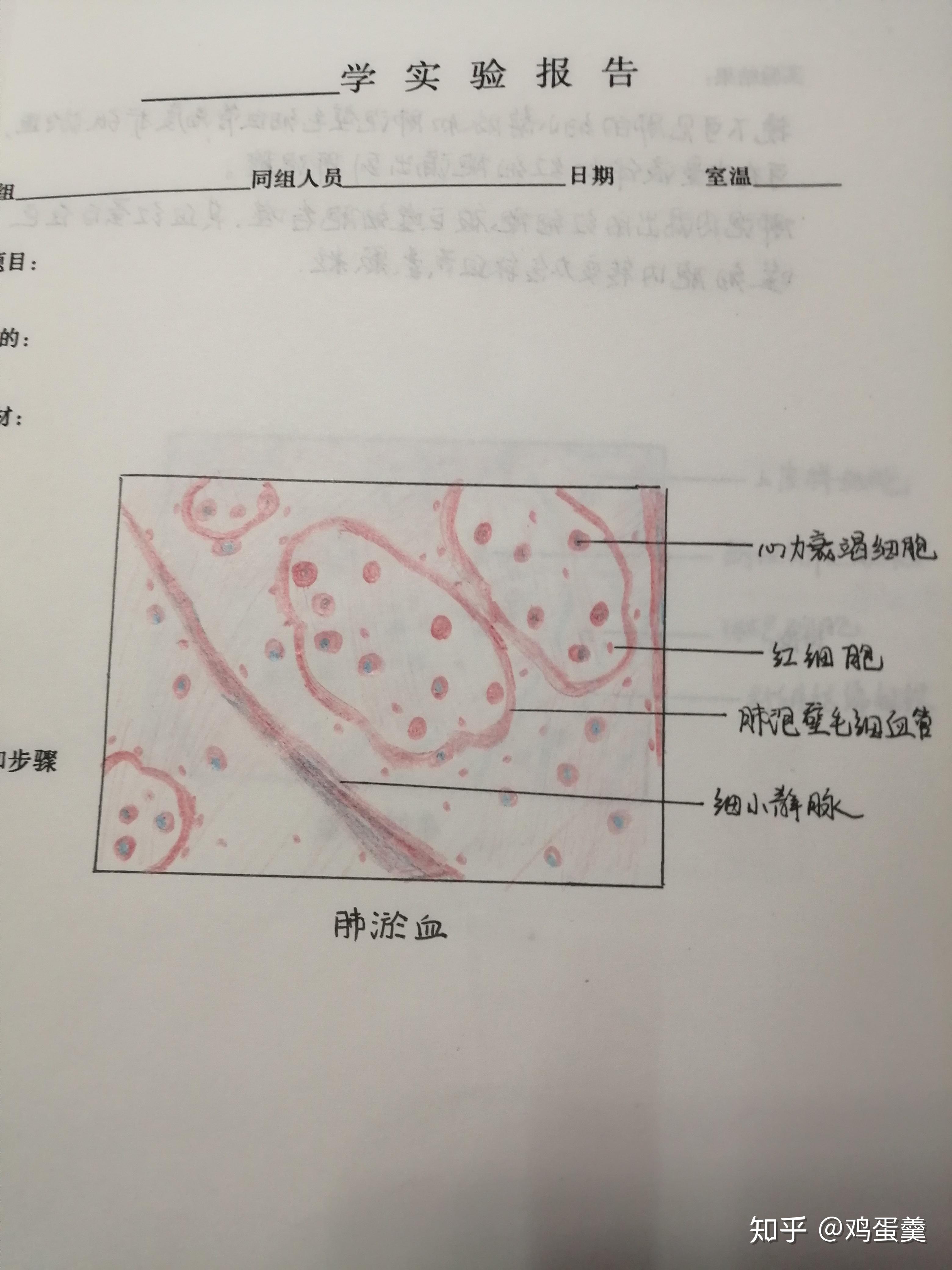 急性肺淤血40×手绘图图片