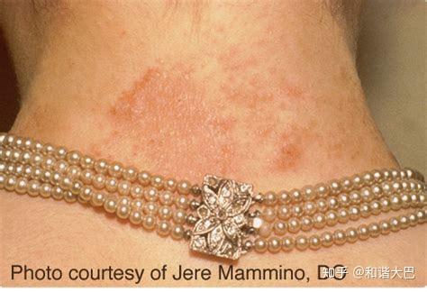 金属过敏是种什么样的体验? - 知乎