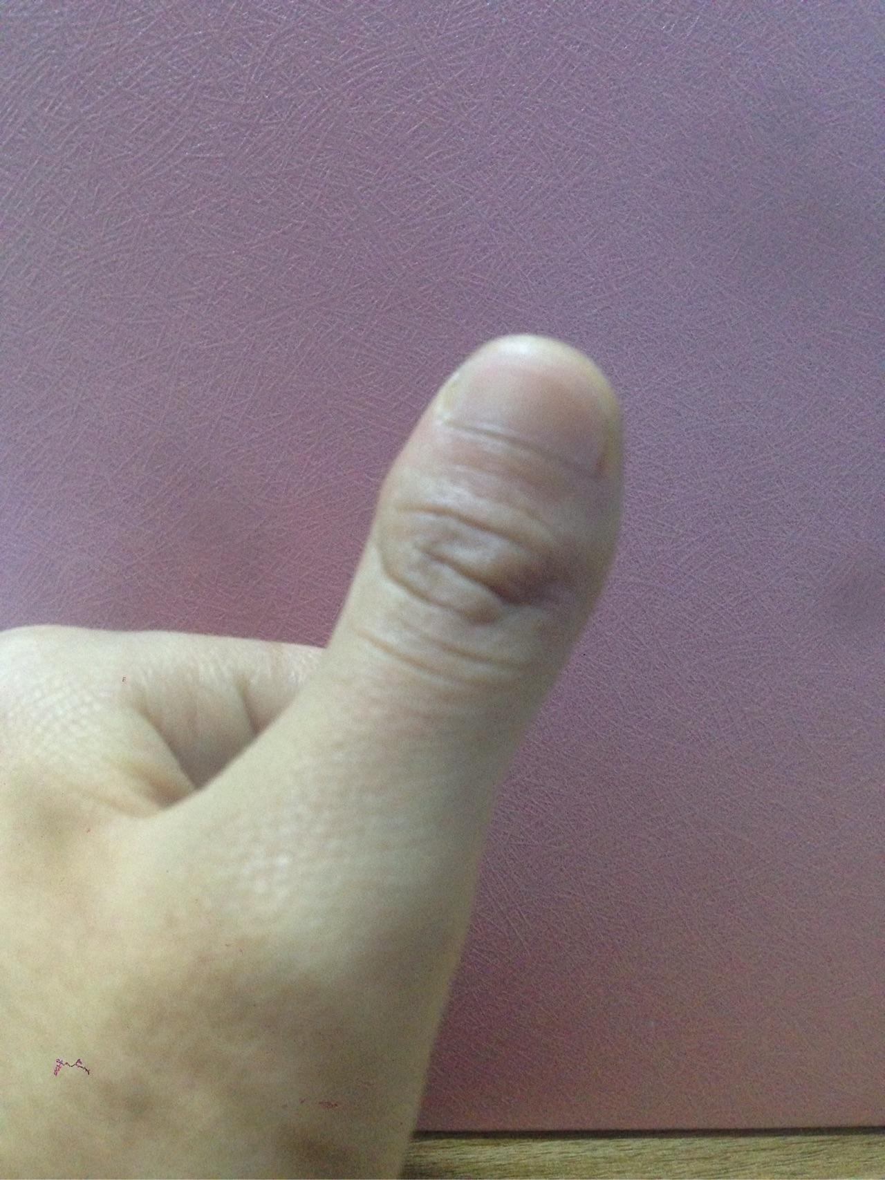 为什么我的大拇指又宽又短