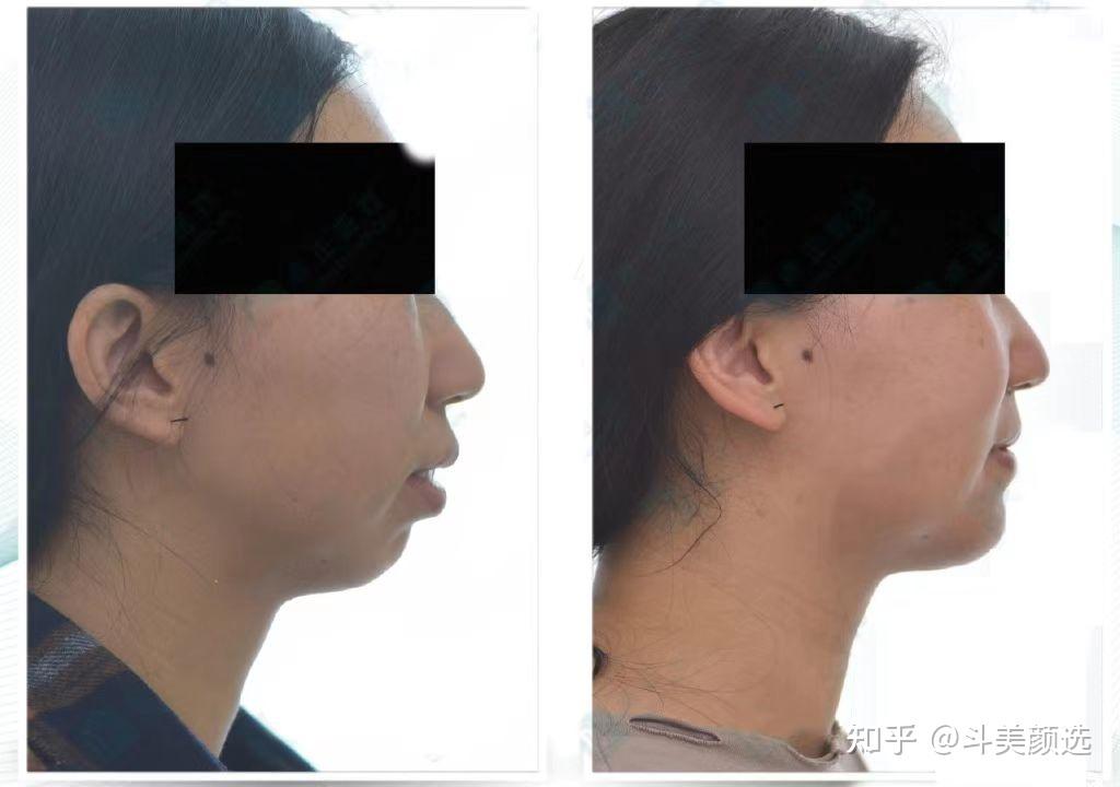 正颌手术要什么条件才可以做直术,不用先正畸牙齿? - 知乎
