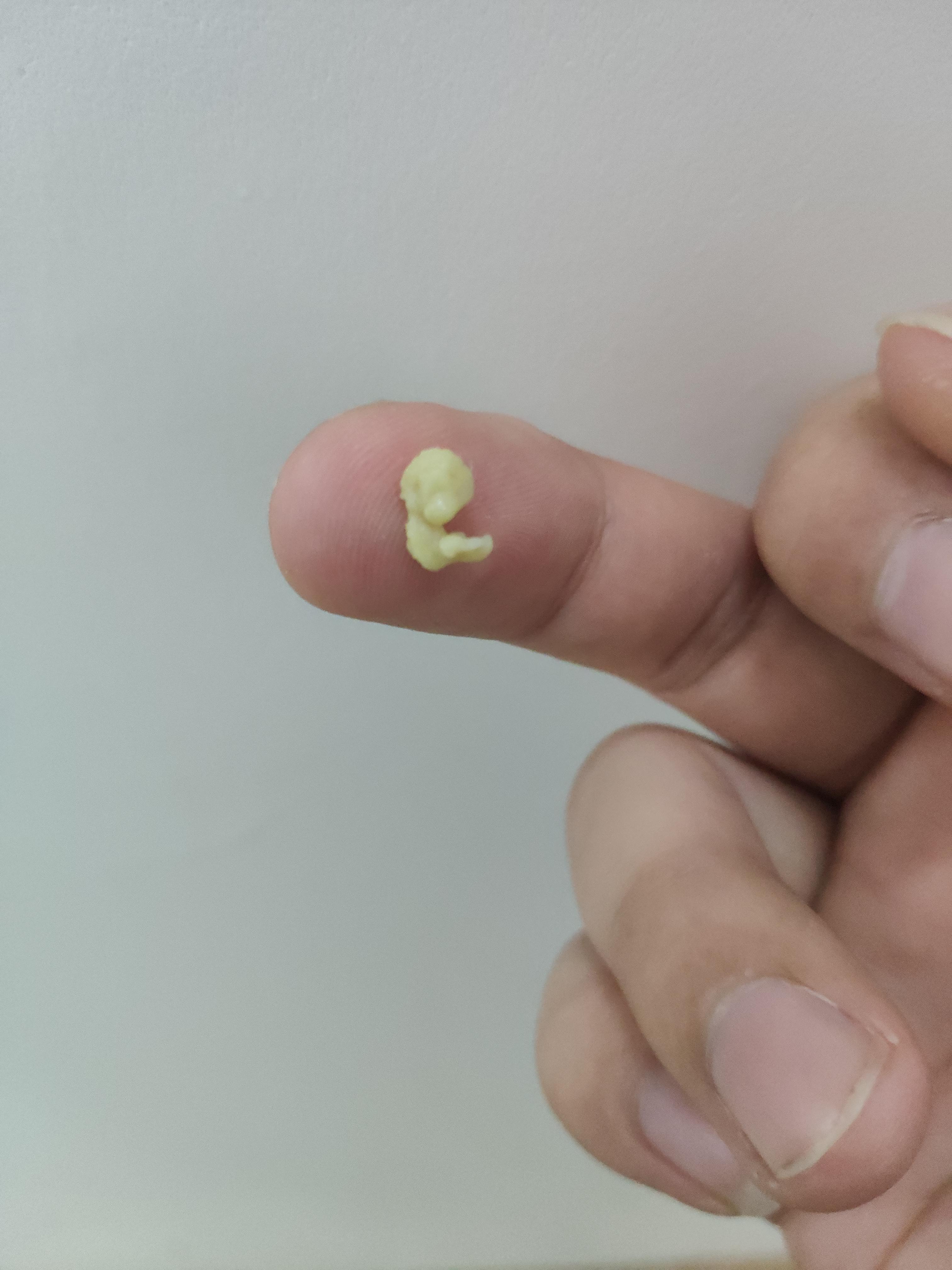 你见过最大的扁桃体结石有多大